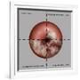 Cervical Cancer Progression, Illustration-Gwen Shockey-Framed Giclee Print