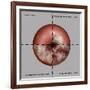 Cervical Cancer Progression, Illustration-Gwen Shockey-Framed Giclee Print