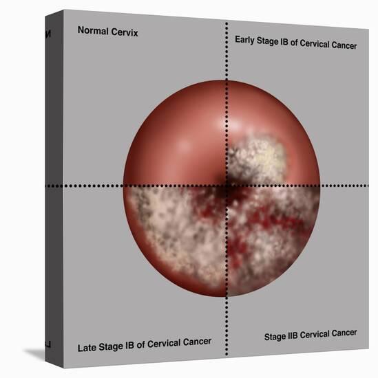 Cervical Cancer Progression, Illustration-Gwen Shockey-Stretched Canvas