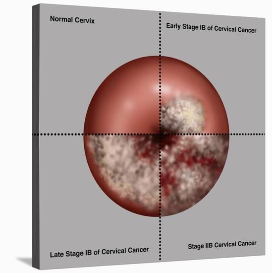 Cervical Cancer Progression, Illustration-Gwen Shockey-Stretched Canvas