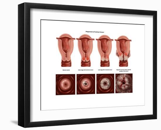 Cervical Cancer-Gwen Shockey-Framed Art Print