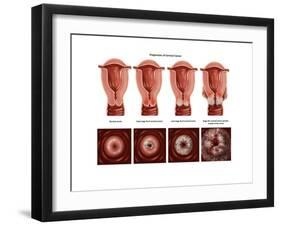 Cervical Cancer-Gwen Shockey-Framed Art Print