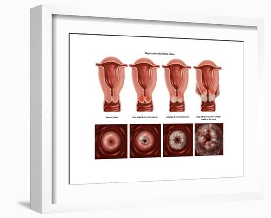 Cervical Cancer-Gwen Shockey-Framed Art Print