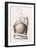 Cesarean Section, Incisions, Illustration, 1822-Science Source-Framed Giclee Print