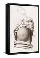 Cesarean Section, Incisions, Illustration, 1822-Science Source-Framed Stretched Canvas