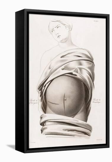 Cesarean Section, Incisions, Illustration, 1822-Science Source-Framed Stretched Canvas