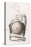 Cesarean Section, Incisions, Illustration, 1822-Science Source-Stretched Canvas