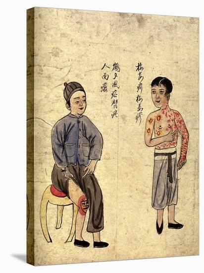 Chinese Men Afflicted With Gonorrhea-null-Stretched Canvas