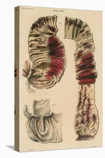 Cholera Infected Intestines, 1808-Science Source-Stretched Canvas