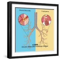 Chronic Obstructive Pulmonary Disease (COPD)-Monica Schroeder-Framed Giclee Print