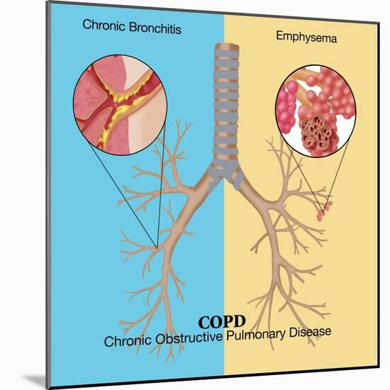 Chronic Obstructive Pulmonary Disease (COPD)-Monica Schroeder-Mounted Giclee Print