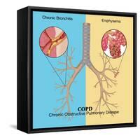 Chronic Obstructive Pulmonary Disease (COPD)-Monica Schroeder-Framed Stretched Canvas