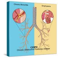 Chronic Obstructive Pulmonary Disease (COPD)-Monica Schroeder-Stretched Canvas