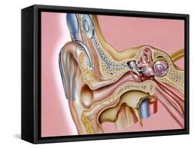 Cochlear Implant, Artwork-John Bavosi-Framed Stretched Canvas