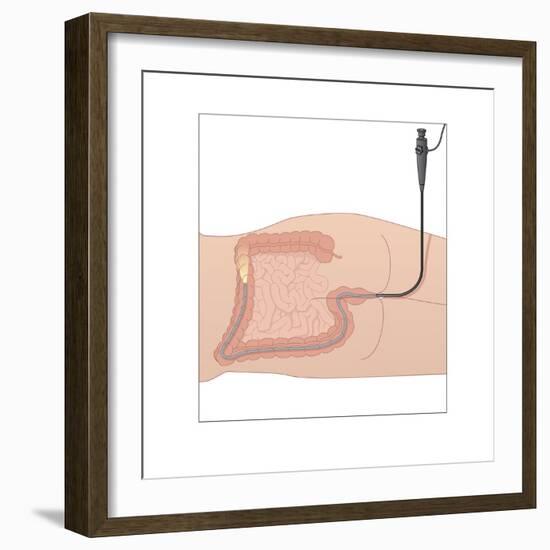 Colonoscopy, Artwork-Peter Gardiner-Framed Photographic Print