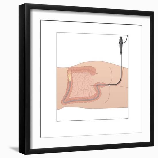 Colonoscopy, Artwork-Peter Gardiner-Framed Photographic Print