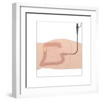 Colonoscopy, Artwork-Peter Gardiner-Framed Photographic Print