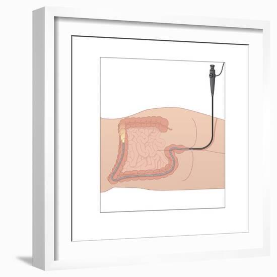 Colonoscopy, Artwork-Peter Gardiner-Framed Photographic Print