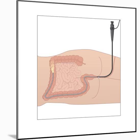 Colonoscopy, Artwork-Peter Gardiner-Mounted Photographic Print