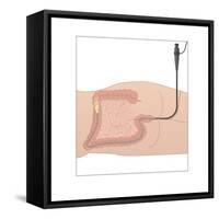 Colonoscopy, Artwork-Peter Gardiner-Framed Stretched Canvas