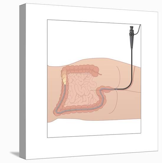 Colonoscopy, Artwork-Peter Gardiner-Stretched Canvas