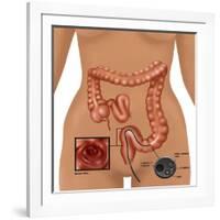 Colonoscopy-Gwen Shockey-Framed Giclee Print