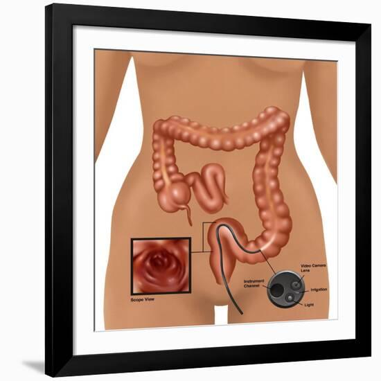 Colonoscopy-Gwen Shockey-Framed Giclee Print