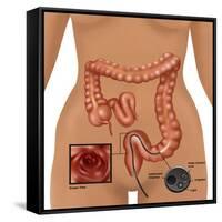 Colonoscopy-Gwen Shockey-Framed Stretched Canvas