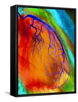 Coloured Angiogram of Coronary Artery of the Heart-Science Photo Library-Framed Stretched Canvas