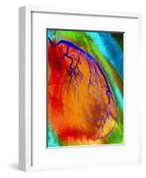 Coloured Angiogram of Coronary Artery of the Heart-Science Photo Library-Framed Photographic Print