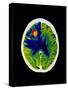 Coloured CT Scan of Brain Abscess In AIDS Patient-Science Photo Library-Stretched Canvas