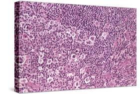 Coloured LM of Hodgkin's Disease In Lymph Tissue-Dr. E. Walker-Stretched Canvas