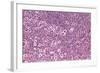 Coloured LM of Hodgkin's Disease In Lymph Tissue-Dr. E. Walker-Framed Premium Photographic Print