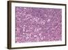 Coloured LM of Hodgkin's Disease In Lymph Tissue-Dr. E. Walker-Framed Premium Photographic Print