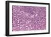 Coloured LM of Hodgkin's Disease In Lymph Tissue-Dr. E. Walker-Framed Photographic Print