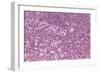 Coloured LM of Hodgkin's Disease In Lymph Tissue-Dr. E. Walker-Framed Photographic Print