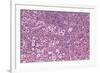 Coloured LM of Hodgkin's Disease In Lymph Tissue-Dr. E. Walker-Framed Photographic Print