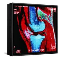 Coloured MRI Scan of Human Knee Joint, Side View-Geoff Tompkinson-Framed Stretched Canvas