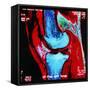 Coloured MRI Scan of Human Knee Joint, Side View-Geoff Tompkinson-Framed Stretched Canvas