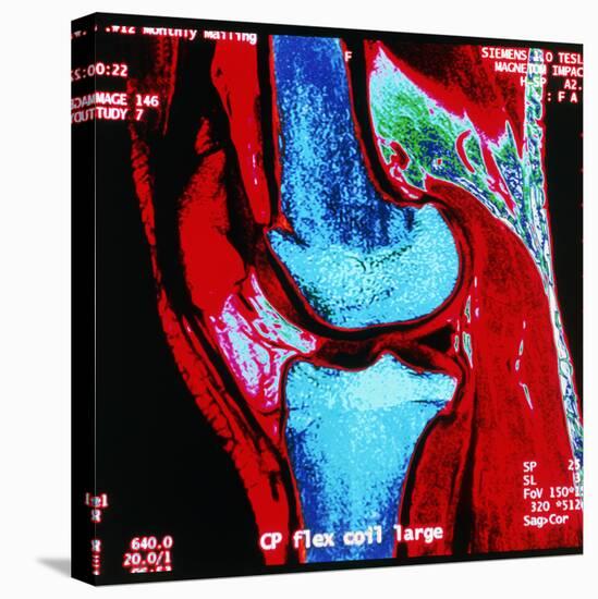 Coloured MRI Scan of Human Knee Joint, Side View-Geoff Tompkinson-Stretched Canvas