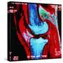 Coloured MRI Scan of Human Knee Joint, Side View-Geoff Tompkinson-Stretched Canvas