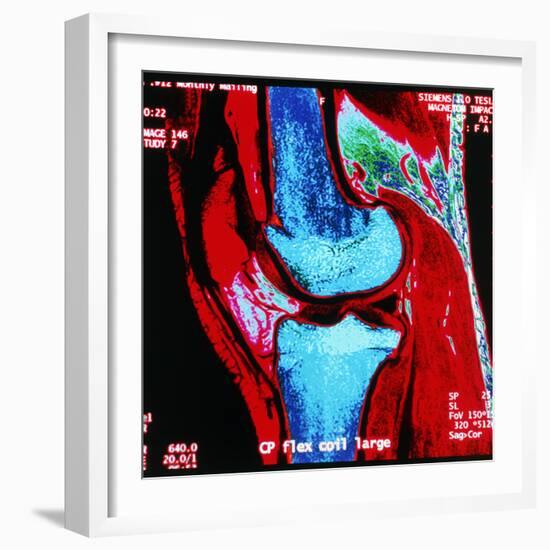 Coloured MRI Scan of Human Knee Joint, Side View-Geoff Tompkinson-Framed Premium Photographic Print
