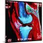 Coloured MRI Scan of Human Knee Joint, Side View-Geoff Tompkinson-Mounted Premium Photographic Print