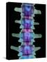 Coloured X-ray of Lumbar Vertebrae of the Spine-Science Photo Library-Stretched Canvas