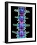 Coloured X-ray of Lumbar Vertebrae of the Spine-Science Photo Library-Framed Photographic Print