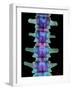 Coloured X-ray of Lumbar Vertebrae of the Spine-Science Photo Library-Framed Photographic Print