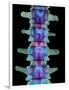 Coloured X-ray of Lumbar Vertebrae of the Spine-Science Photo Library-Framed Photographic Print