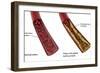 Comparison of a healthy artery and an unhealthy artery with plaque build-up inside.-Stocktrek Images-Framed Art Print