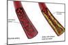 Comparison of a healthy artery and an unhealthy artery with plaque build-up inside.-Stocktrek Images-Mounted Art Print