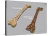 Comparison of a Healthy Bone and a Bone with Osteoporosis-null-Stretched Canvas